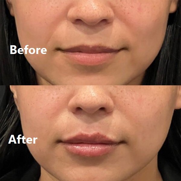 Lip Flip Before and After